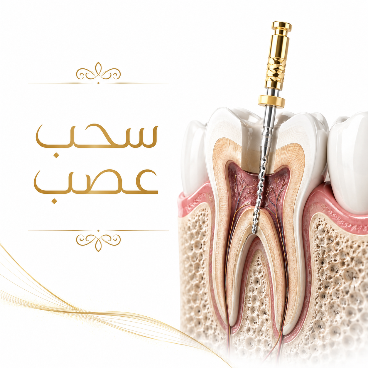 سحب عصب وعلاج جذور