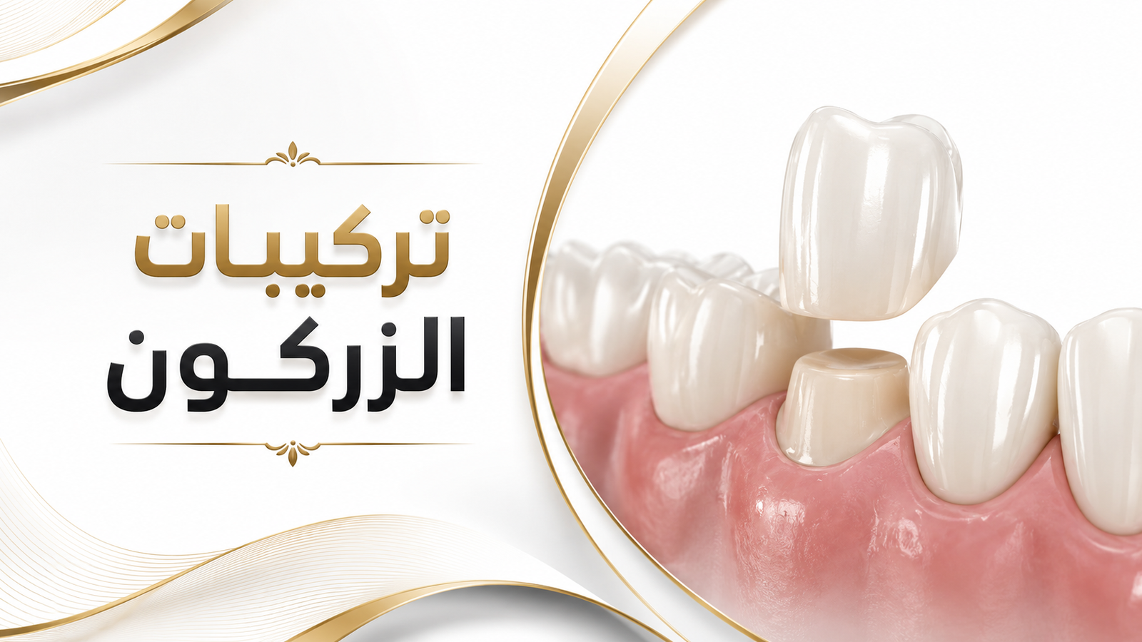 تركيبات الزركون في صنعاء