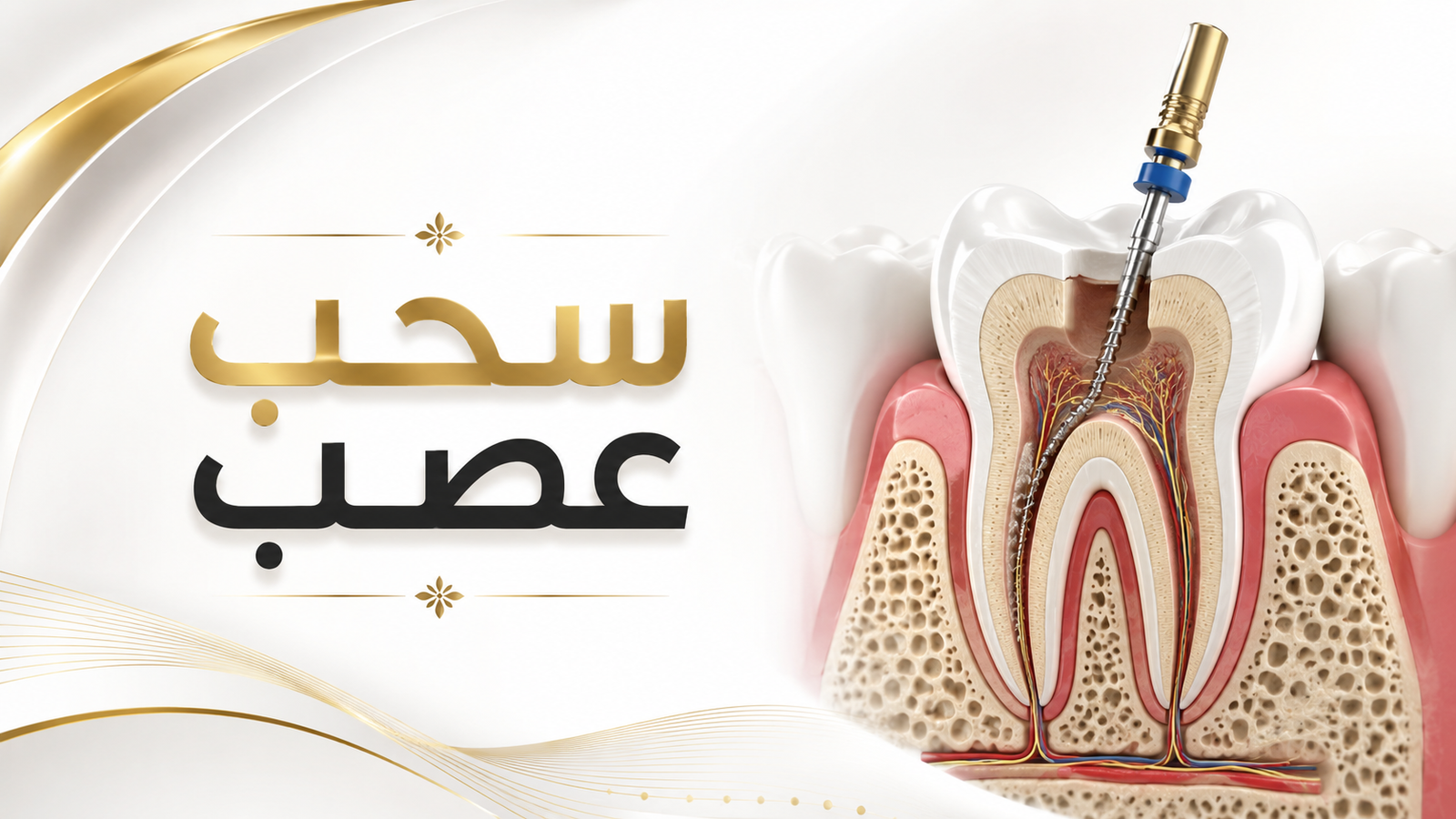 سحب عصب وعلاج جذور في صنعاء