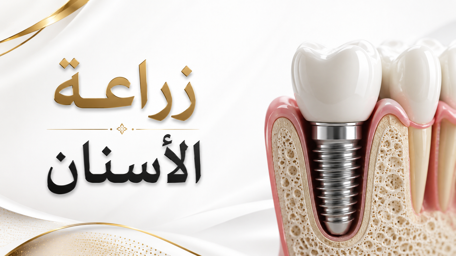 زراعة الأسنان في صنعاء | التقييم والخطوات الأساسية